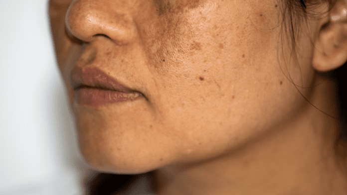 _Pigmentation of Skin Pigmentation of Skin