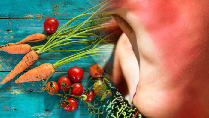 food for sunburn pain food for sunburn pain