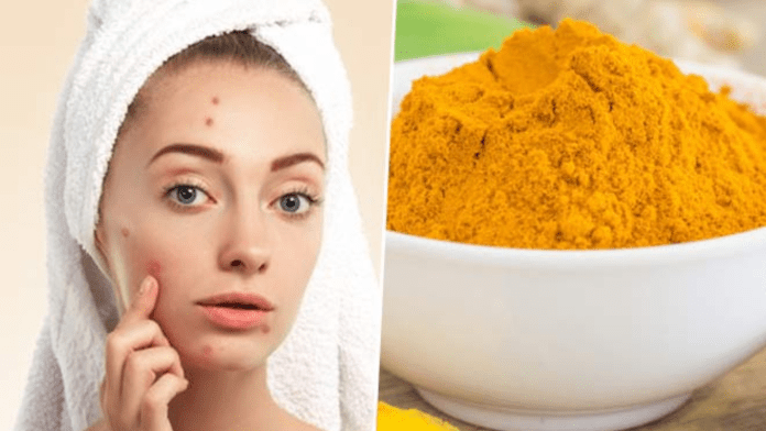 turmeric acne turmeric acne